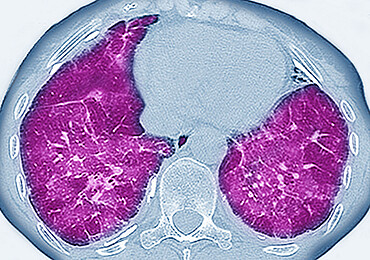 Pulmonary fibrosis (lesion of the lungs characterized by the presence of excess fibrous connective tissue), chest scanner