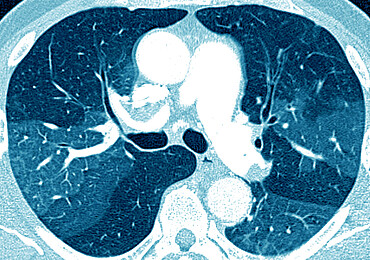 Pulmonary fibrosis (lesion of the lungs characterized by the presence of excess fibrous connective tissue), chest scanner