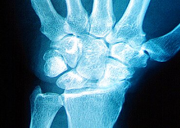 Wrist Osteoarthritis, X-Ray