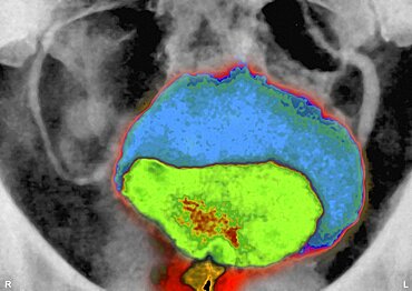 Prostatic Adenoma, X-Ray