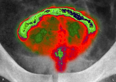 Prostatic Adenoma, X-Ray