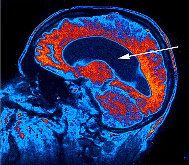 Hydrocephalus, Scan