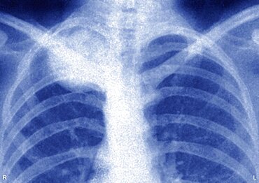 Ewings Sarcoma, X-Ray