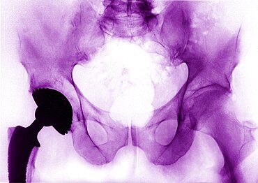 Hip Prosthesis,  X-Ray