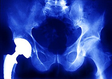 Hip Prosthesis,  X-Ray