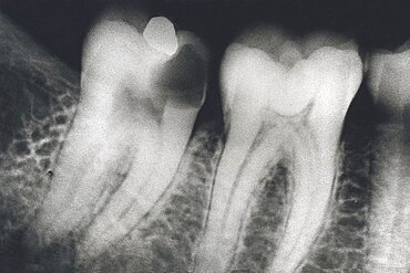 Tooth  Decay, X-Ray