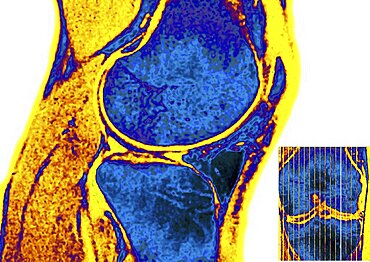 Healthy Knee, MRI