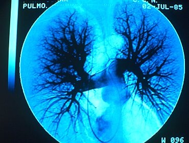 Lung Angiography For Emphysema