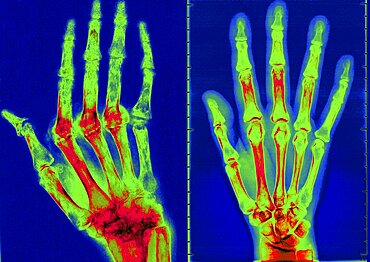 Rheumatoid Arthritis, X-Ray