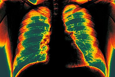 Lung, X-Ray Result