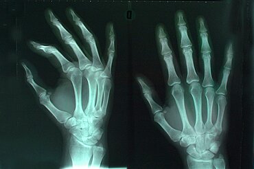 Hand, X-Ray