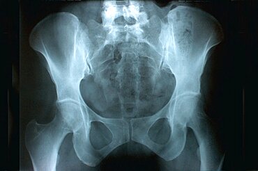 Hip, X-Ray Result