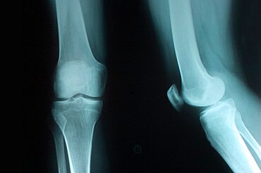 Knee, X-Ray