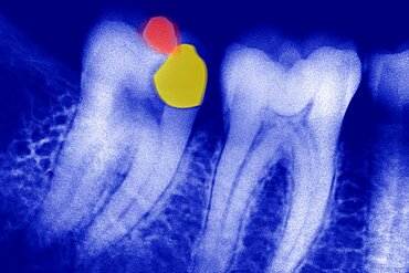 Dental Filling,  X-Ray