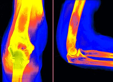 Myeloma on Elbow, X-Ray