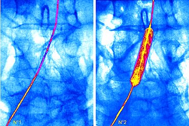 Arterial Angioplasty, Result