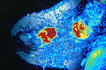 MRI, Breast Cancer
