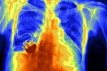 Pacemaker, X-Ray, Frontal View