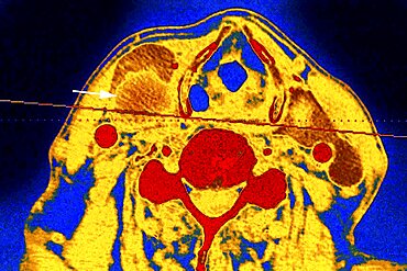 Thyroid Nodule, Scan