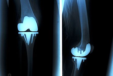 Knee Prosthesis, X-Ray