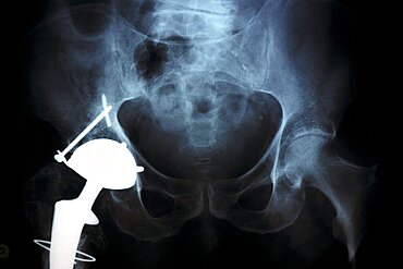 Hip Prosthesis, X-Ray