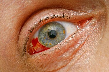 Ophthalmology - Eye Injury