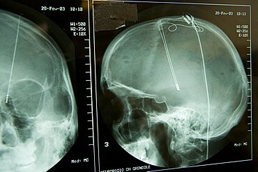 Brain Electrostimulation, X-Ray