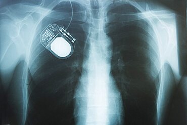 Nerve Stimulator implanted in Chest, X-Ray