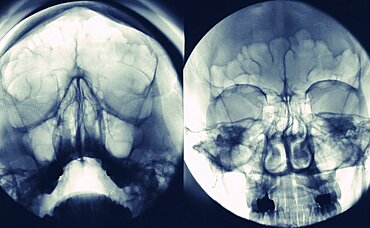 Sinus, X-Ray