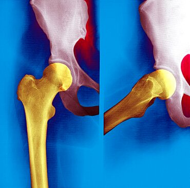 Normal Hip, X-Ray