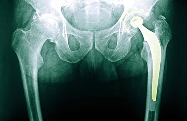 Hip Prosthesis, X-Ray