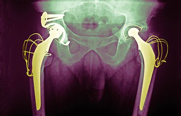 Hip Prosthesis, X-Ray