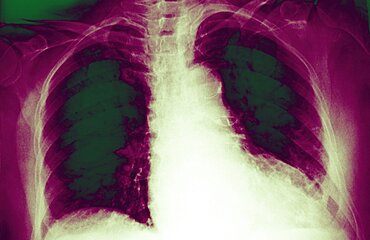 Cardiomegaly, X-Ray