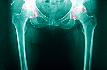 Hip Osteoarthritis, X-Ray