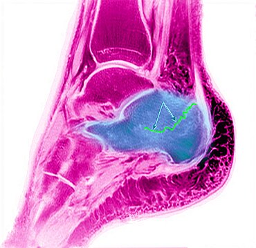 Foot, Fractured Calcaneum, X-Ray