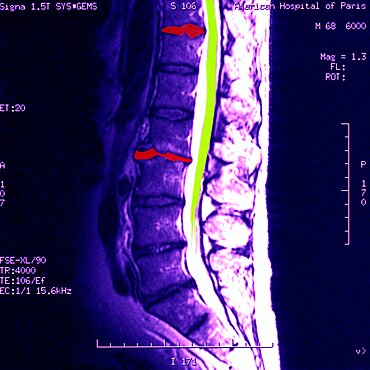 Vertebral Osteoarthritis, MRI