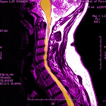 Cervical Osteoarthritis, MRI