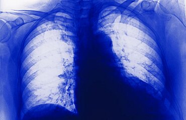 Cardiomegaly, X-Ray