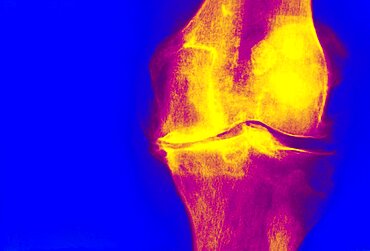 Knee Osteoarthritis, X-Ray