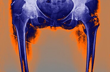 Hip Osteoarthritis, X-Ray