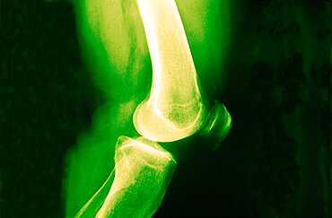 Knee Osteoarthritis, X-Ray