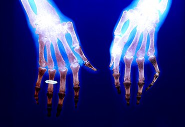 Rheumatoid Arthritis, X-Ray