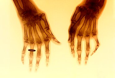 Rheumatoid Arthritis, X-Ray