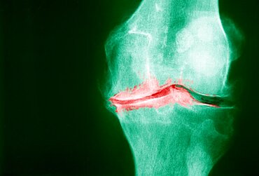 Knee Osteoarthritis, X-Ray