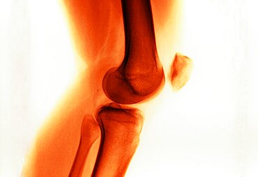 Knee Osteoarthritis, X-Ray