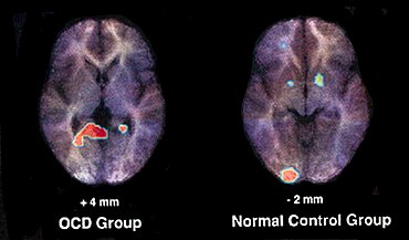 PET Scan, Normal and OCD Brain