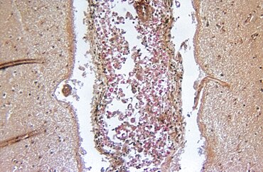 Cryptococcosis, LM