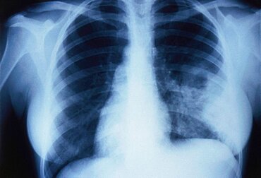Non-encapsulated Cryptococcosis, X-ray
