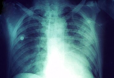 Human Plague, Chest X-ray