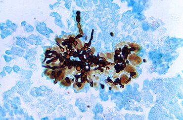 Candida albicans, Fungal Infection, LM